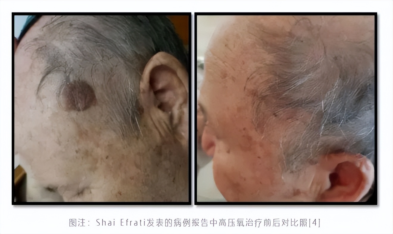 breakthrough! Israeli scientists 180 days of high pressure 100 oxygen