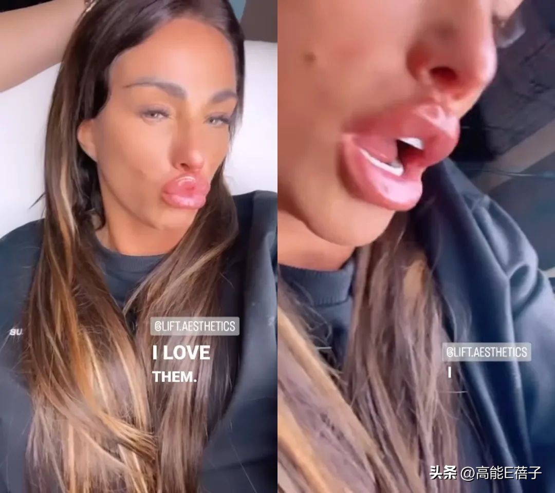 The 45yearold British actress turned her lips into sausage lips of