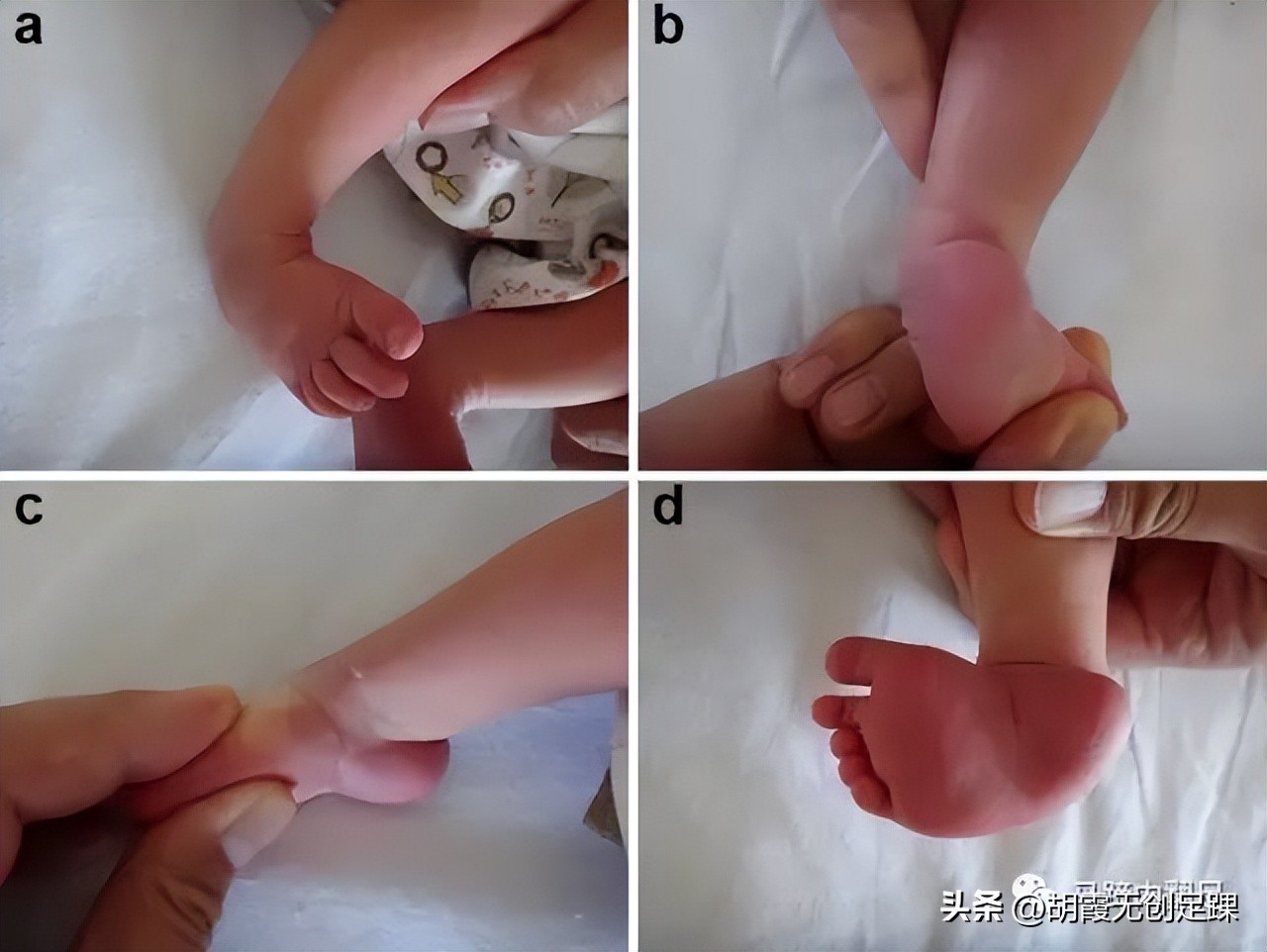 What causes baby's feet to turn inward? Is it related to genetics? - iNEWS
