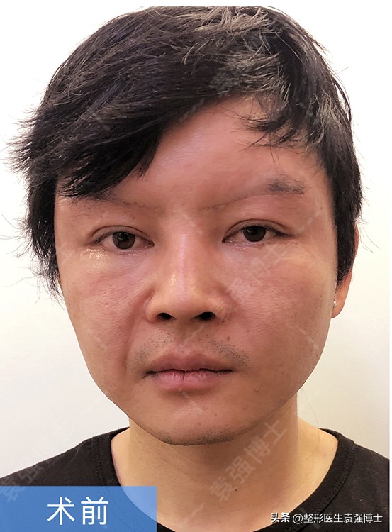 Is There An Age Limit For Facelift Surgery Can t Exceed 3 Times In A Lifetime Hear The Doctor 