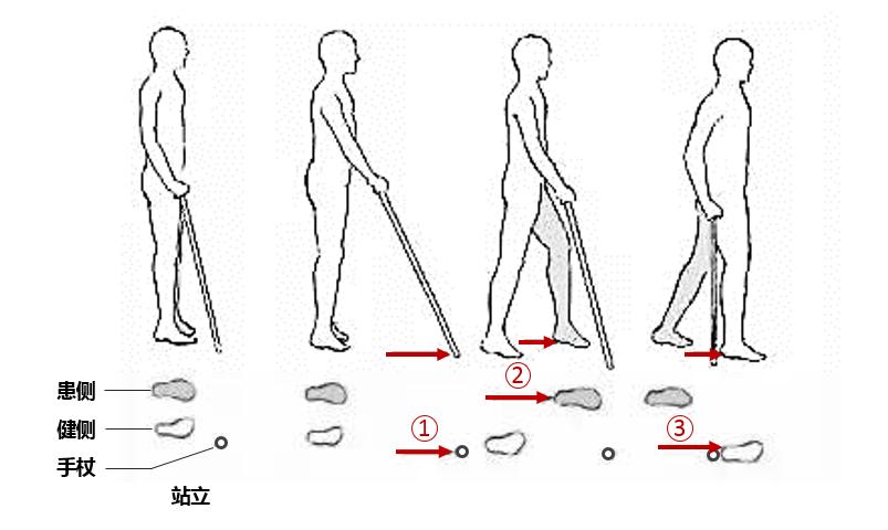 How to do walking training after stroke? - iMedia