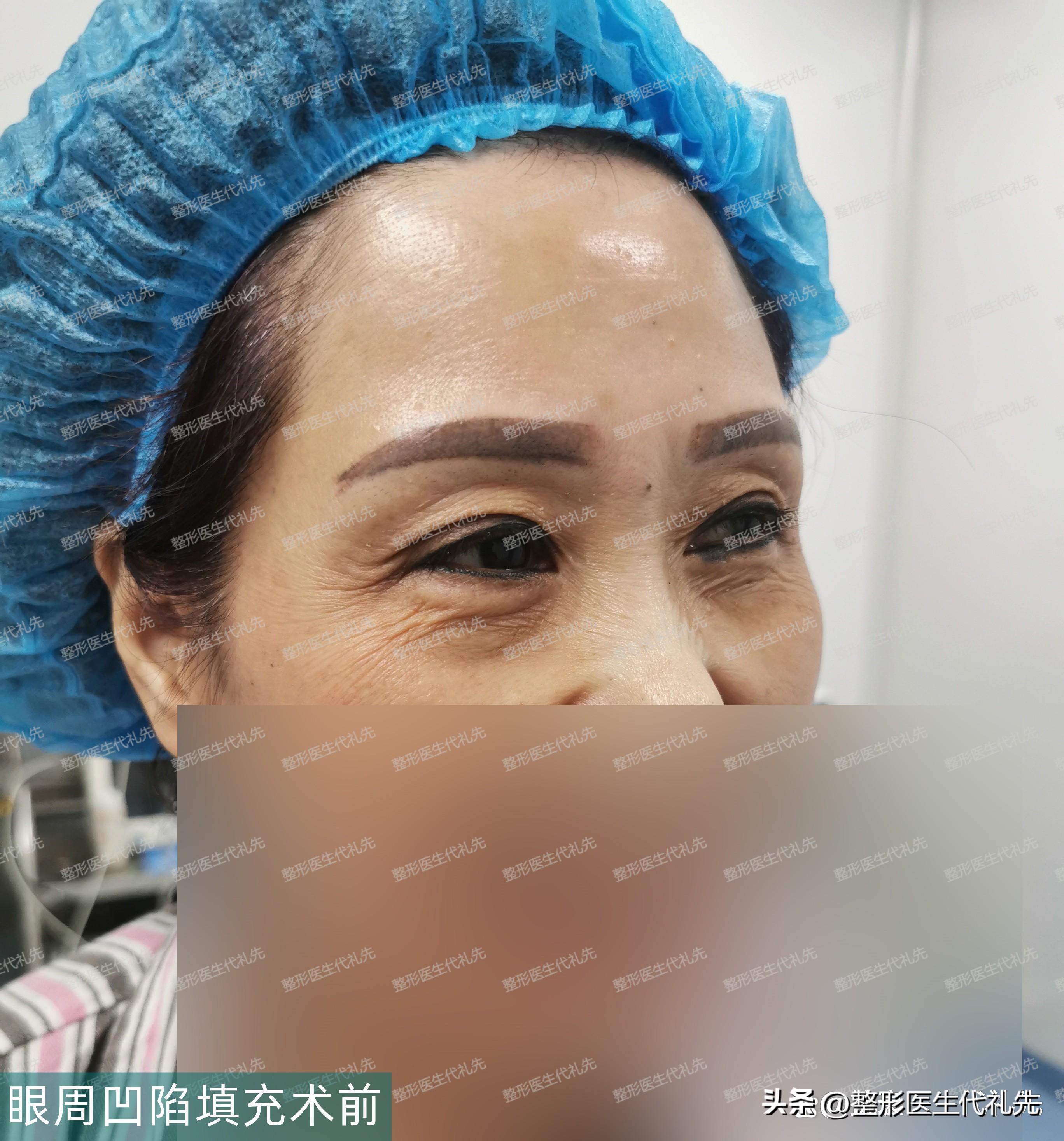 The sunken eye sockets are more old than the apple muscle nasolabial