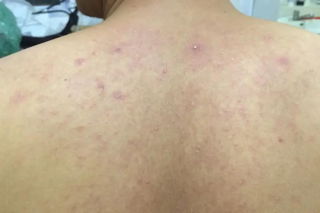 why-do-i-always-get-pimples-on-my-back-inews