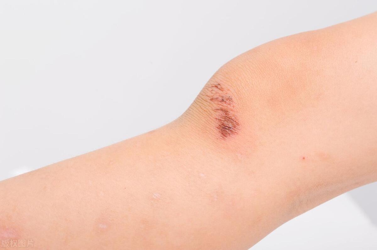 What's the matter with the wound not scabbing for a long time? Will