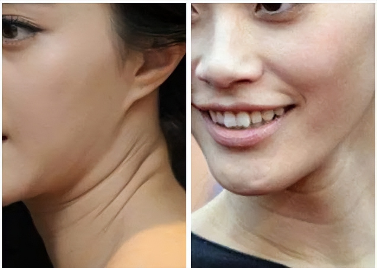 Deep neck lines can be solved in 3 ways to make you look younger - iNEWS