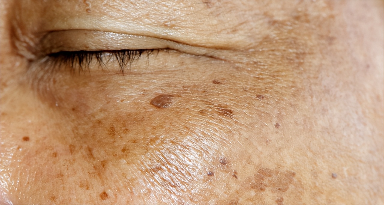 Can eating grapes often fade spots? Doctor If you want to lighten