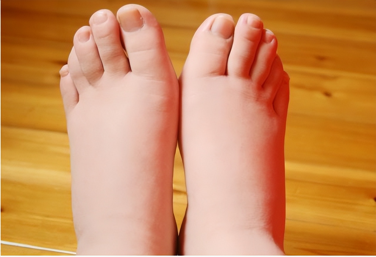 My feet are swollen after eating protein powder! Protein powder hurts