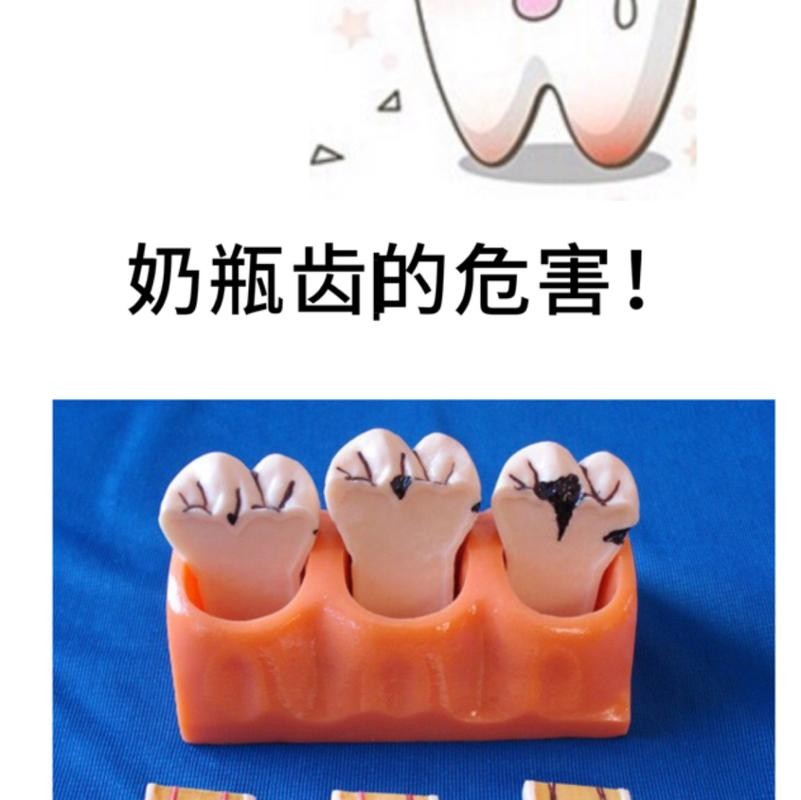 Baby bottle teeth causes, hazards and countermeasures, prevention and