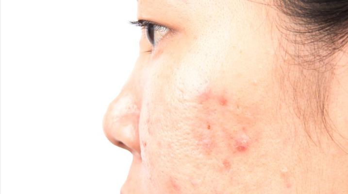 What causes acne on eyebrows - iNEWS