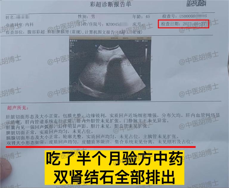 Dr. Hu's medical record sharing Kidney stones were excreted by