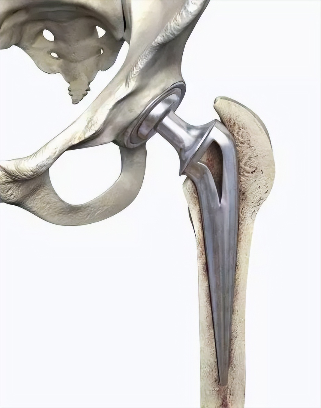 Half Hip Replacement or Total Hip Replacement? What is "half" and what