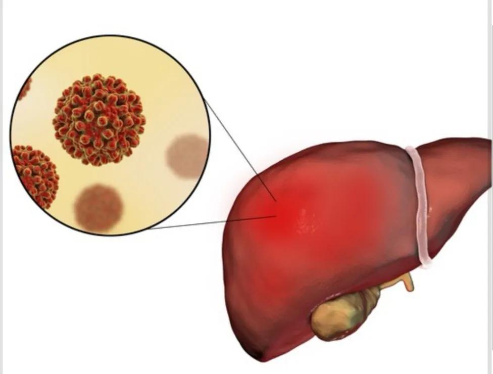 Can drinking really cause liver cancer? iNEWS