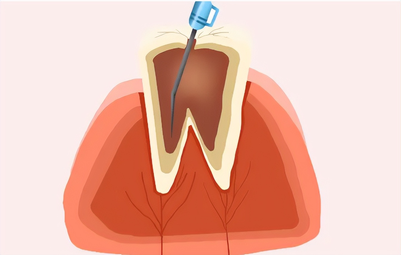 Your tooth needs root canal treatment!Why can't you just fill your
