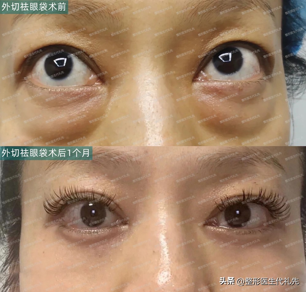 Eye bags What are the main causes of eye bags? iMedia