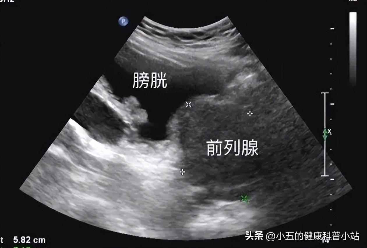What should I do if the elderly have increased nocturia?Take 4 kinds of