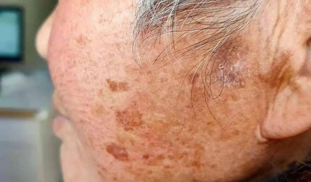 can-age-spots-be-removed-completely-tell-you-a-quick-way-to-get-rid-of