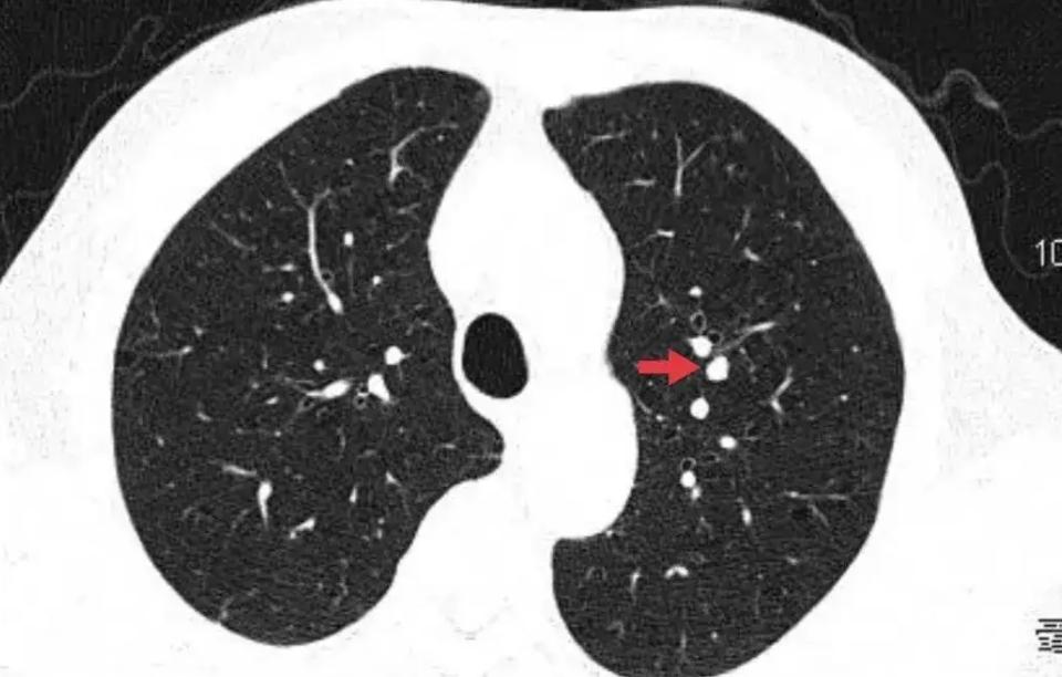 People with "lung nodules" in the body should touch less of the three