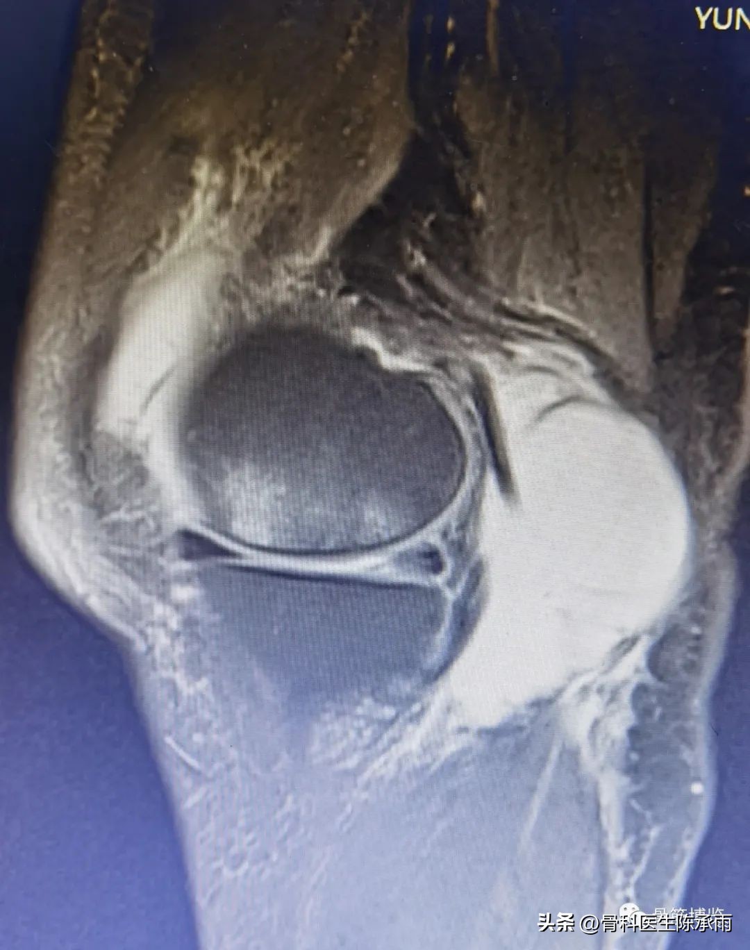 Rheumatoid Knee Arthritis Complicated With Popliteal Cyst Is Different Arthroscopic Resection