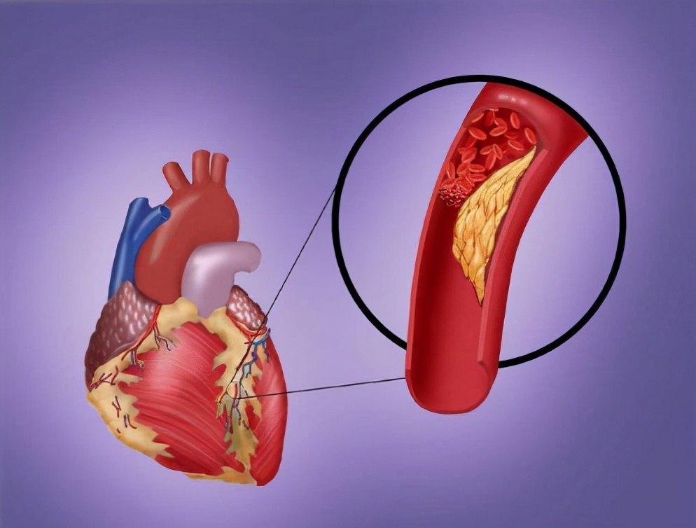 How Many Years Can You Live After A Heart Stent Is Installed The Doctor