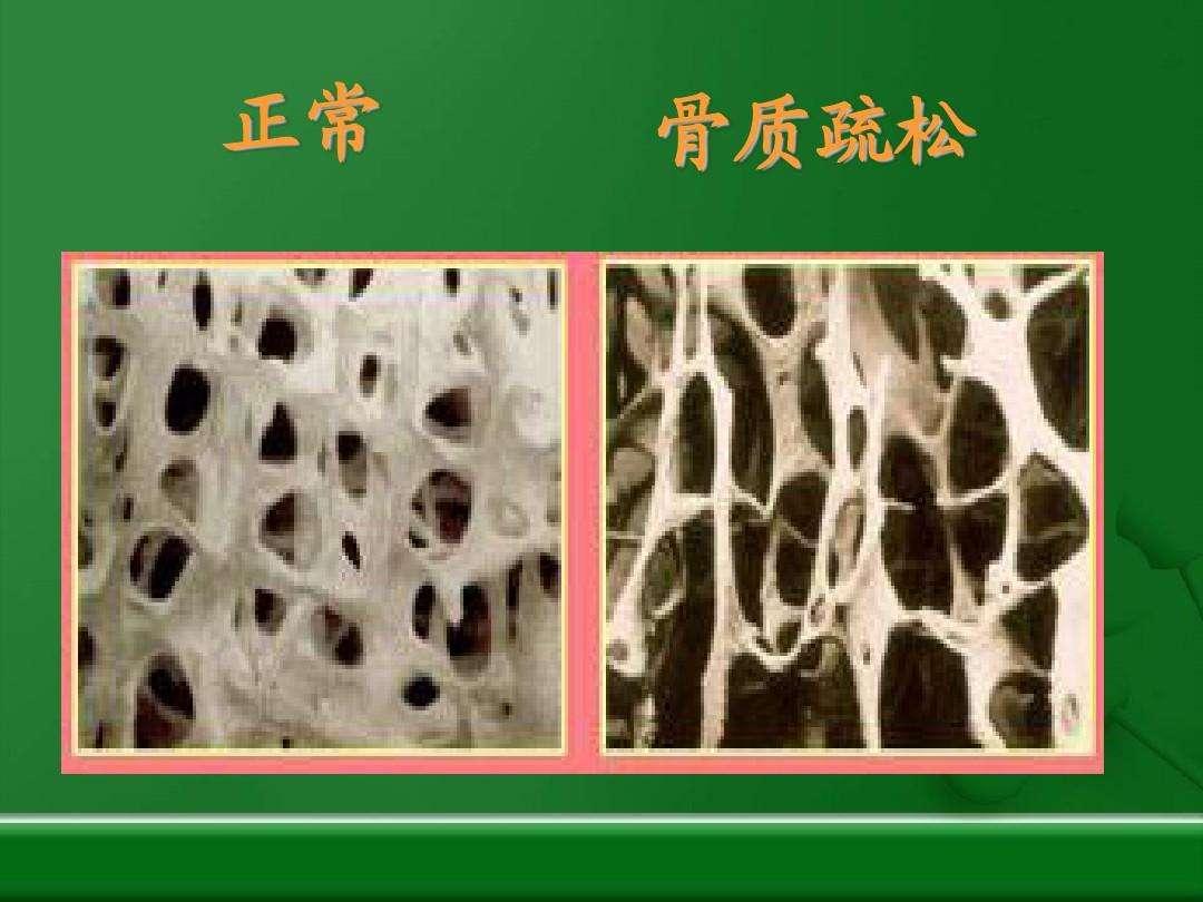 One thing hurts bones more than monosodium glutamate, the doctor