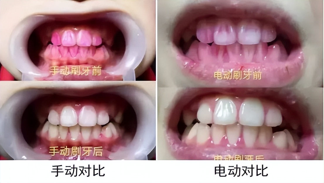 Can I use an electric toothbrush for root canal treatment?Three hidden