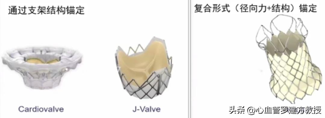 Prof. Jianfang Luo: Valve Anchoring Mechanism and Paravalvular Leakage ...