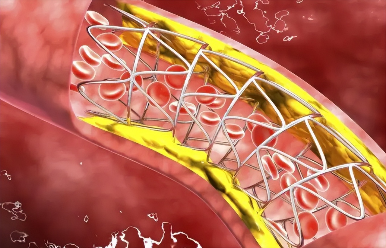 Will the installation of a heart stent affect the human body?How do you