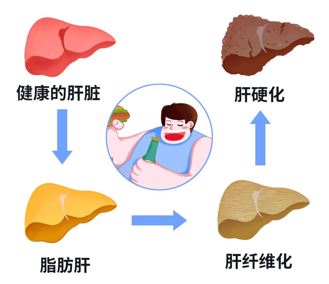 TCM treatment of liver disease Fatty liver was treated at the source, and it was successfully