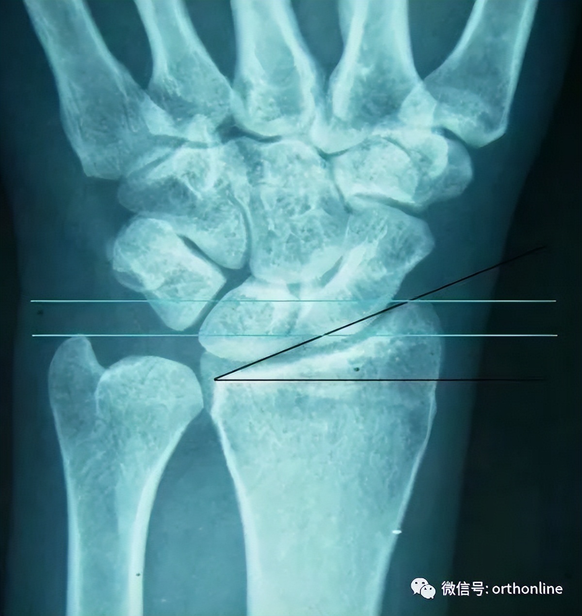 Closed Reduction And Fixation Of Distal Radius Fractures Inews