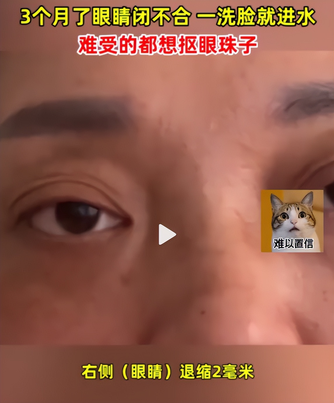 A woman with 3,000 bags under her eyes for 3 months couldn't close her