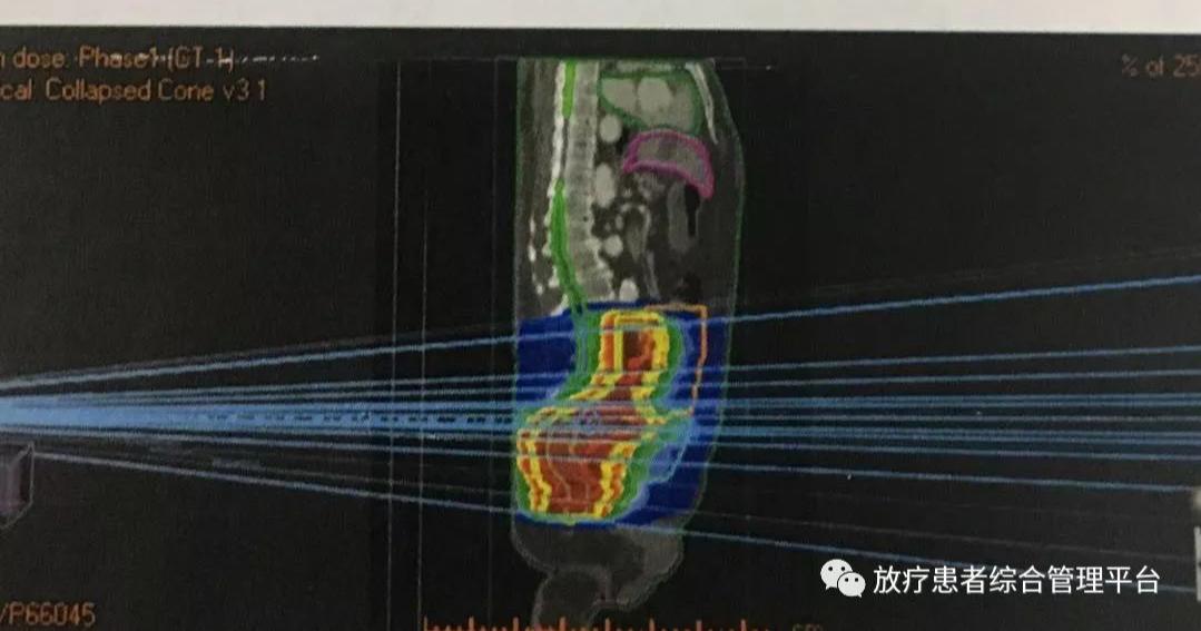 Image Panel Radiotherapy