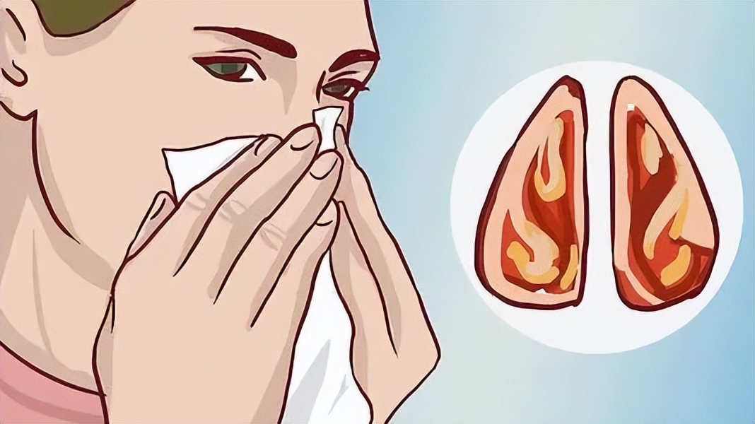 What causes rhinitis? - iNEWS