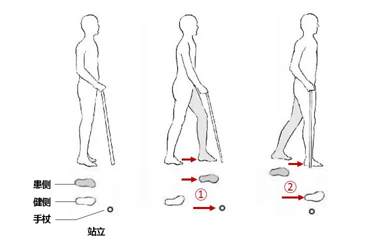 How to do walking training after stroke? - iMedia