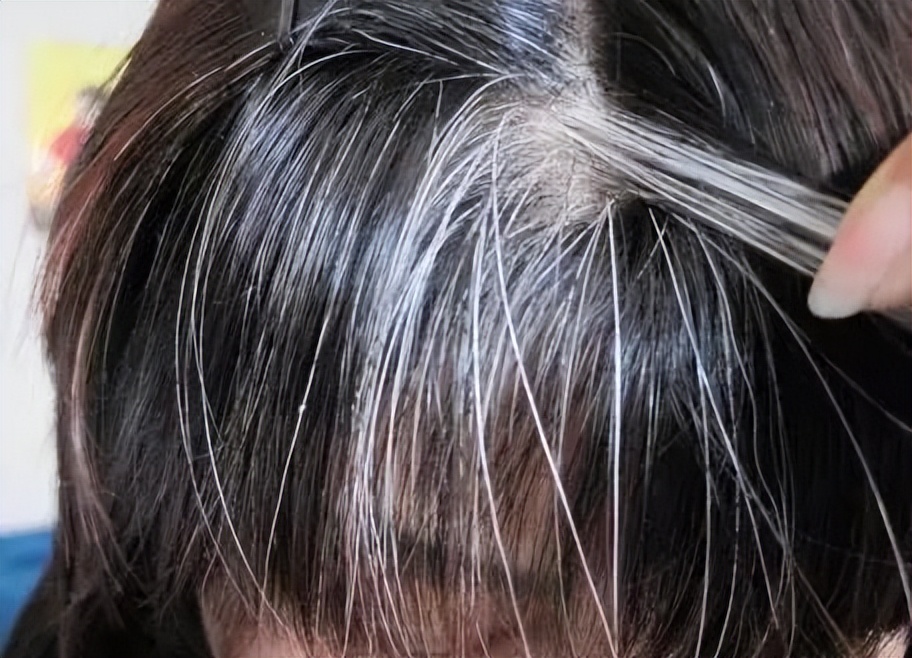 Why do white hair grow longer?May be lack of these 4 nutrients, scientific supplement iNEWS