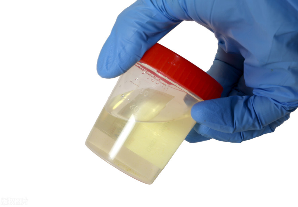 Urine is yellow and smelly? Or the body suggests these 3 things to you