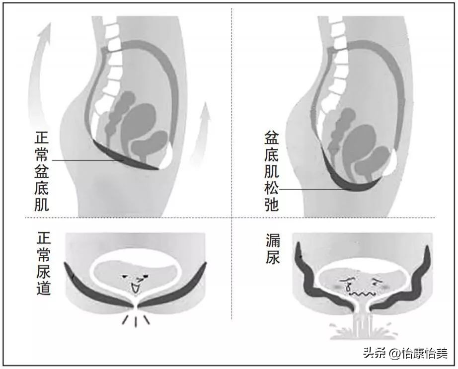 "Pelvic floor muscle relaxation" Can't hold back urine? These 8 yoga