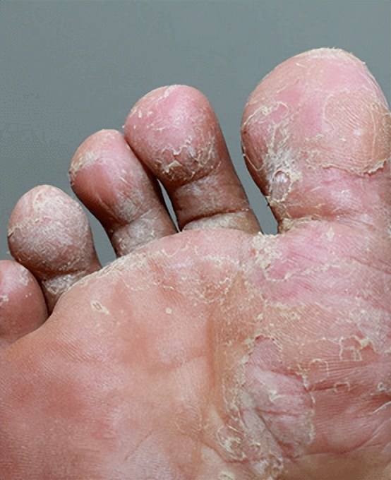 Sweat herpes recurring is not good!Doctor If you want to get rid of it