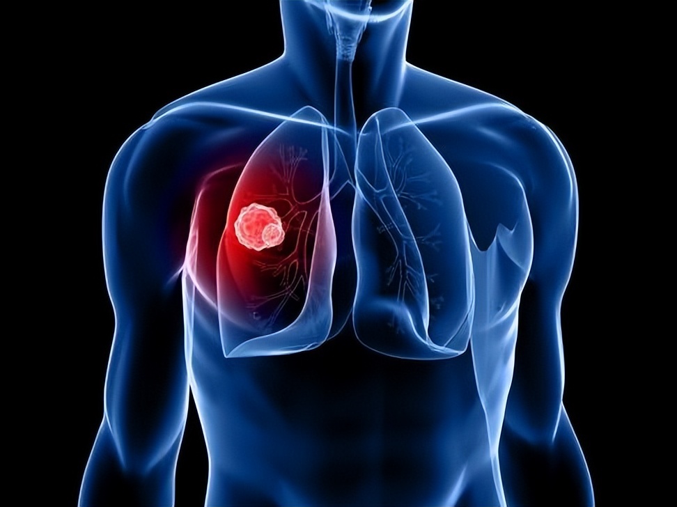 Can you get lung cancer if you don't smoke?5 high risk factors for lung