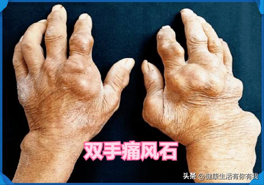 Can taking baking soda tablets for a long time reduce uric acid?Is