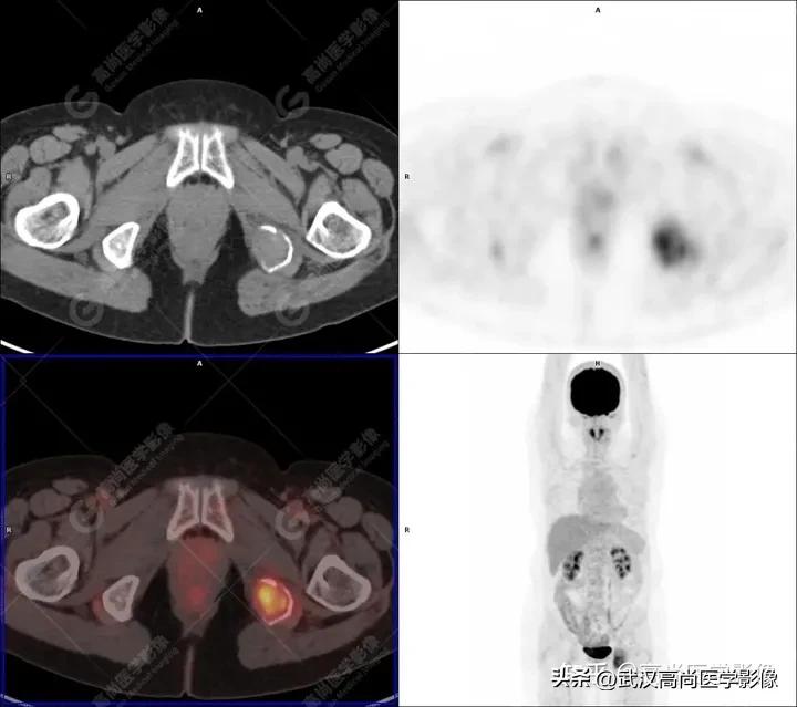 Two cases of plasmacytoma detected by PET/CT 