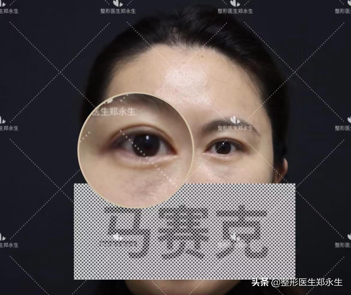 At the age of 30, I decided to use this method after sticking cucumbers