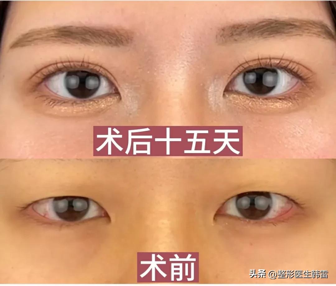How long does it take for threadburied double eyelids to return to normal? iMedia