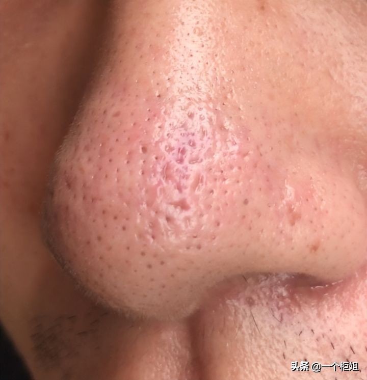 My nose has large pores and can squeeze out yellow oil particles, what