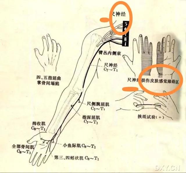 Diabetic peripheral neuropathy has the risk of amputation, domestic acetyl Lcarnitine is very