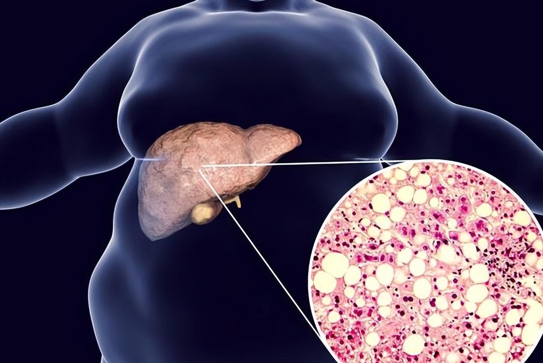Study: Why Type 2 Diabetes and Obesity Predispose to Fatty Liver ...