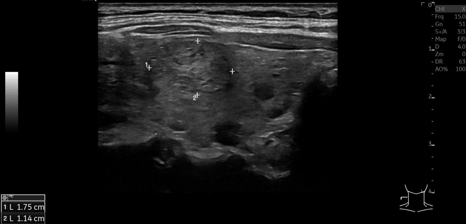 Interpretation of Thyroid Ultrasound Examination Report Are Class 3