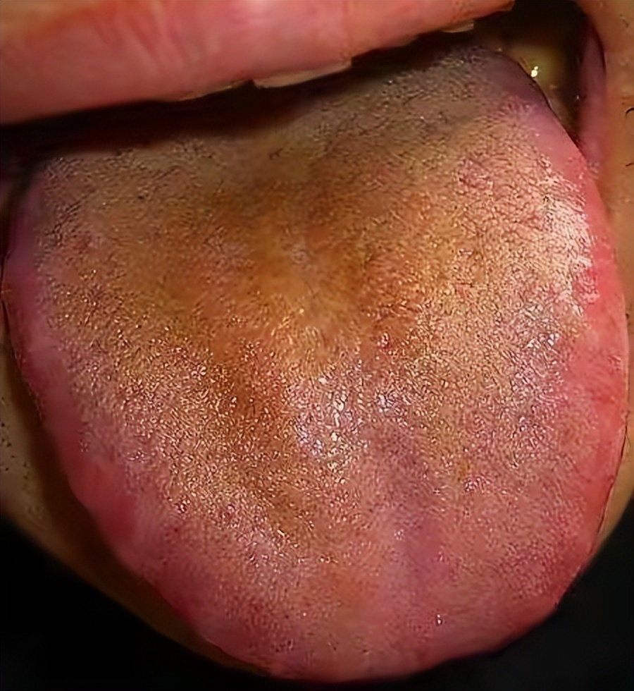 Damp heat in the body, how to get rid of it?4 Different Chinese Patent