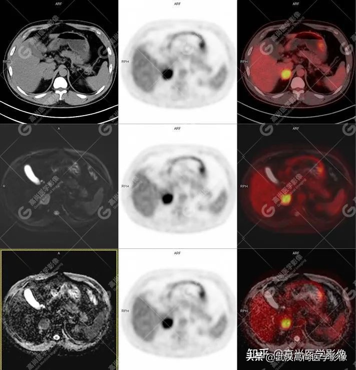 PET/CT-MR Multimodal Imaging: Pheochromocytoma 