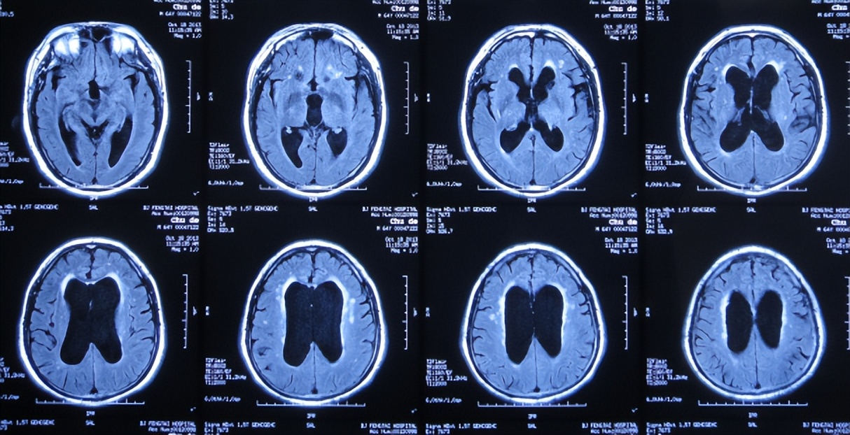 Normal stress hydrocephalus in the elderly: dementia, walking very ...