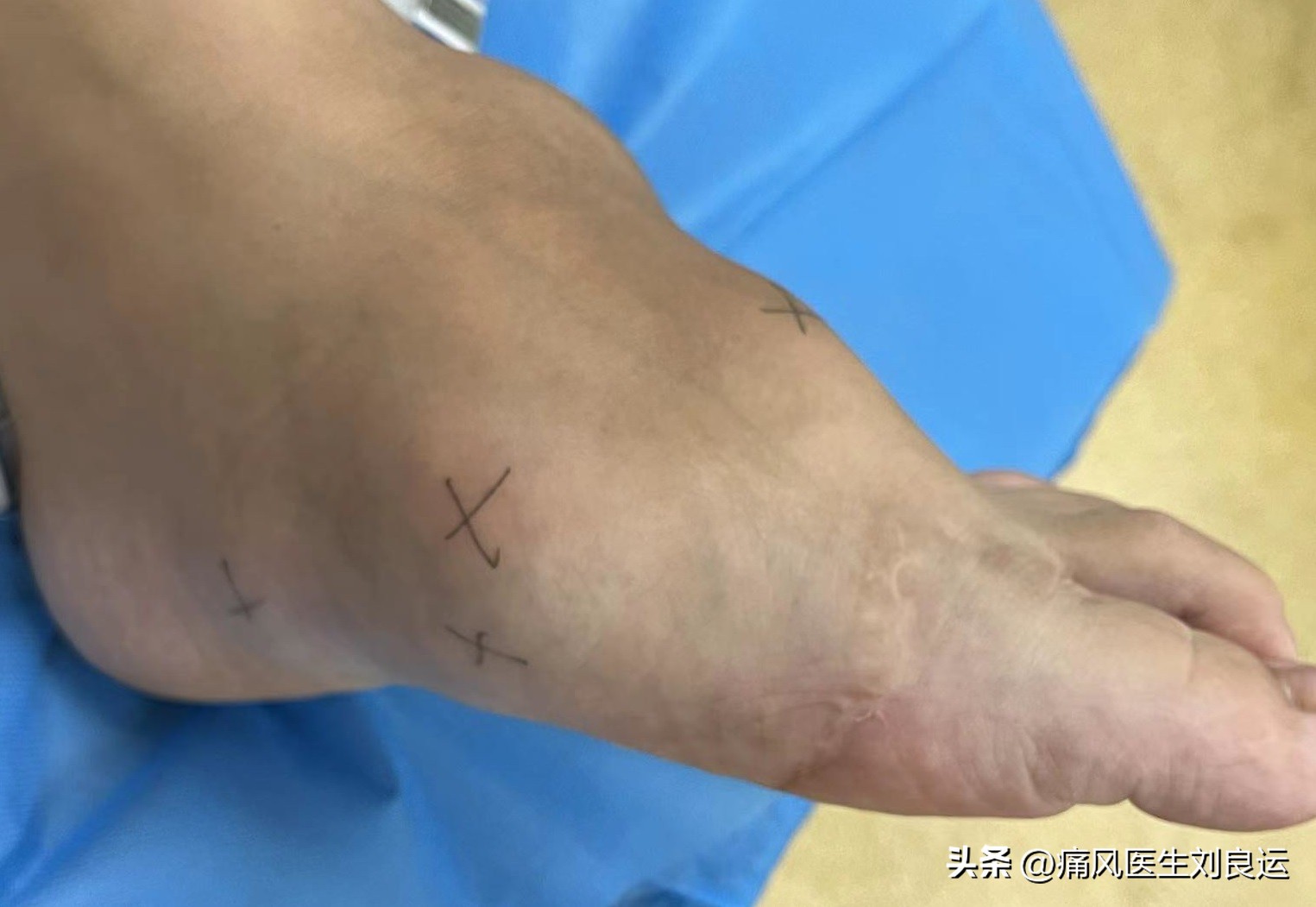 The treatment of gout requires standard treatment. What is the standard